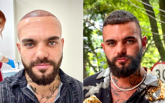 „Kamaráti mi dávali pocítiť, že mám kúty.“ Títo známi Slováci a Česi si dali napichať vlasy, koľko ich to stálo?