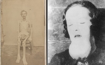 „Živá kostra“ a žena, ktorá žila 25 rokov v izbe s vlastnými výkalmi. 10 najdesivejších fotiek z histórie
