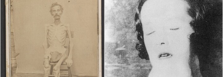 „Živá kostra“ a žena, ktorá žila 25 rokov v izbe s vlastnými výkalmi. 10 najdesivejších fotiek z histórie
