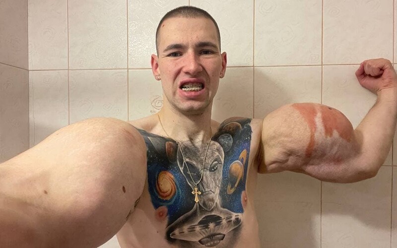 VIDEO: Ruskému „Pepku námořníkovi“ hrozí amputace rukou či až smrt. Operace jeho olejem naplněných bicepsů je riskantní.