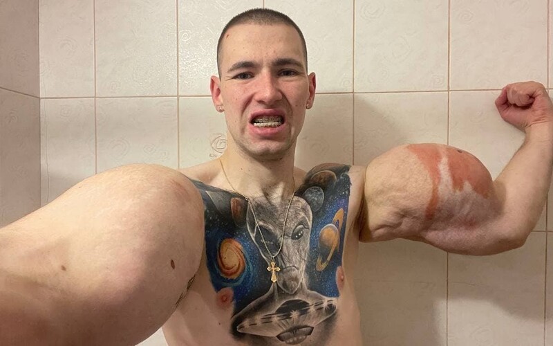 VIDEO: Ruskému „Pepkovi námorníkovi" hrozí amputácia rúk či až smrť. Operácia jeho olejom naplnených bicepsov je riskantná.