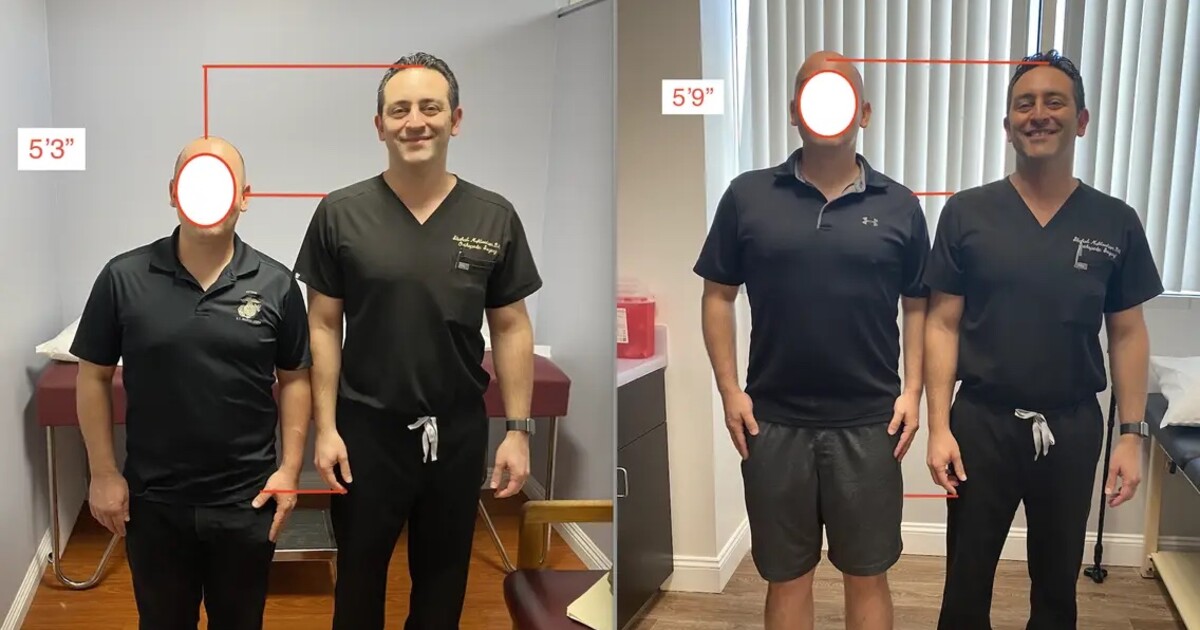 Kontroverzní trend z TikToku, při kterém se lámou a prodlužují nohy, je mezi muži stále populárnější