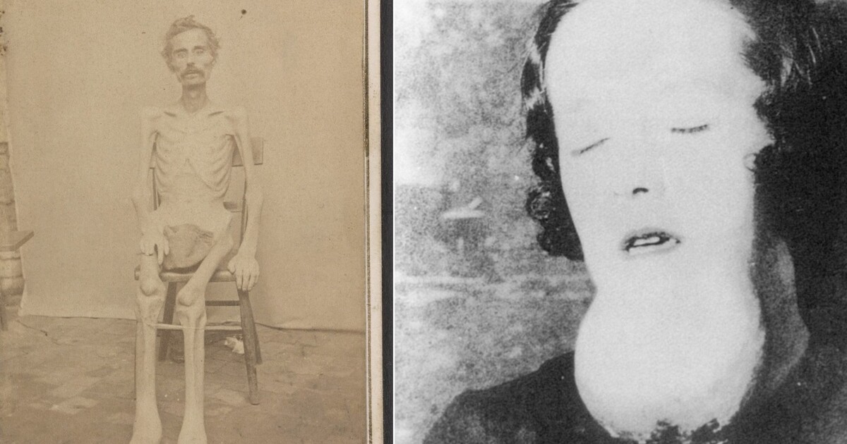 „Živá kostra“ a žena, která žila 25 let v místnosti se svými výkaly. 10 fotografií z historie, které dodnes děsí lidstvo