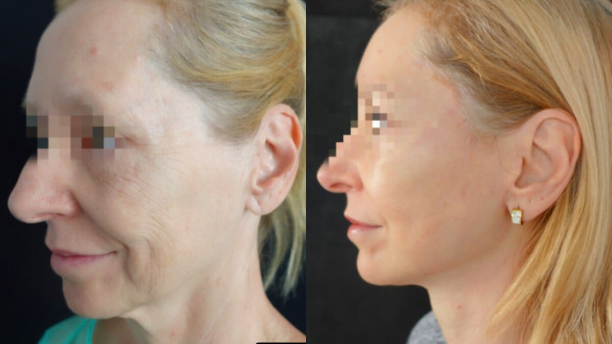 Pred a po zákroku deep plane face lift.