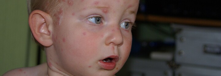 Na jižní Moravě hygienici evidují u dětí osmkrát víc neštovic než loni