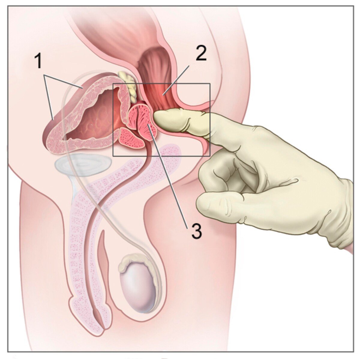Snímka rektálneho vyšetrenia: 1 – močový mechúr, 2 – konečník a 3 – prostata.