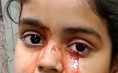11letá dívka z Indie pláče krev. Její matka je zoufalá, lékaři se nemohou shodnout na příčině onemocnění