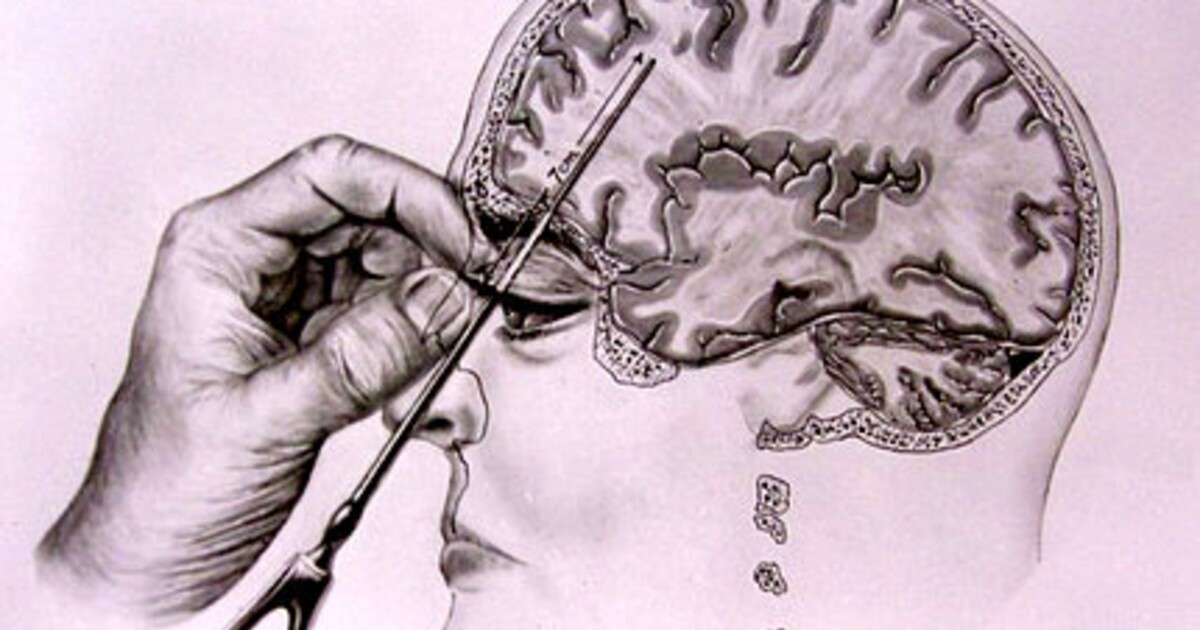 Lobotomie kradla lidem osobnosti, dělala z nich „slintající zombie“