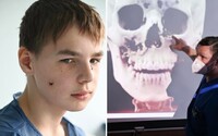 14-ročného chlapca zasiahli počas bombardovania Charkova. V Bratislave mu lekári operovali tvár
