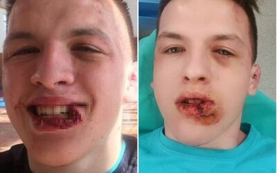 16-ročný slovenský MMA bojovník utrpel škaredé zranenie počas prípravy v Tatrách