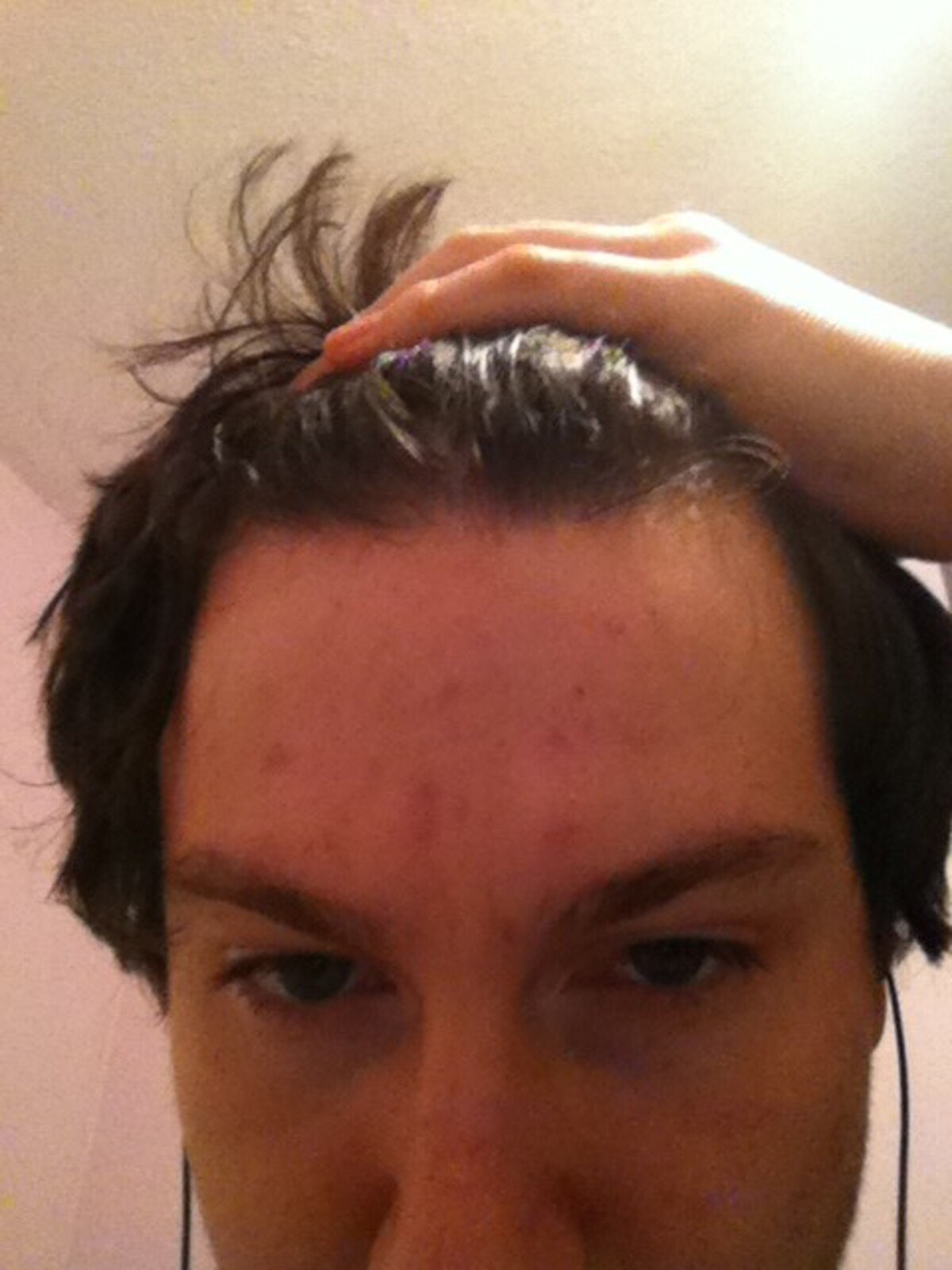 acne, akné, vyrážky