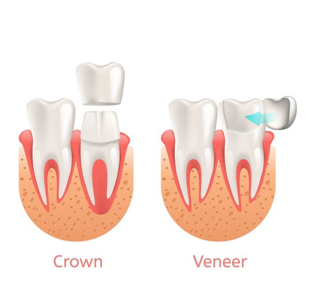 Rozdiel medzi zubnými korunkami (vľavo) a fazetami (vpravo).