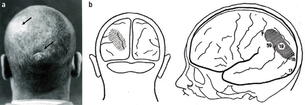 Ilustrácia znázorňuje povrchové poranenie a časť mozgu, v ktorej došlo k poškodeniu.