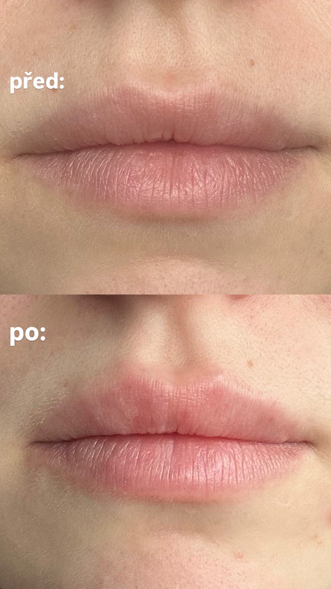 hyaluronic acid, lip filler, výplň rtů
