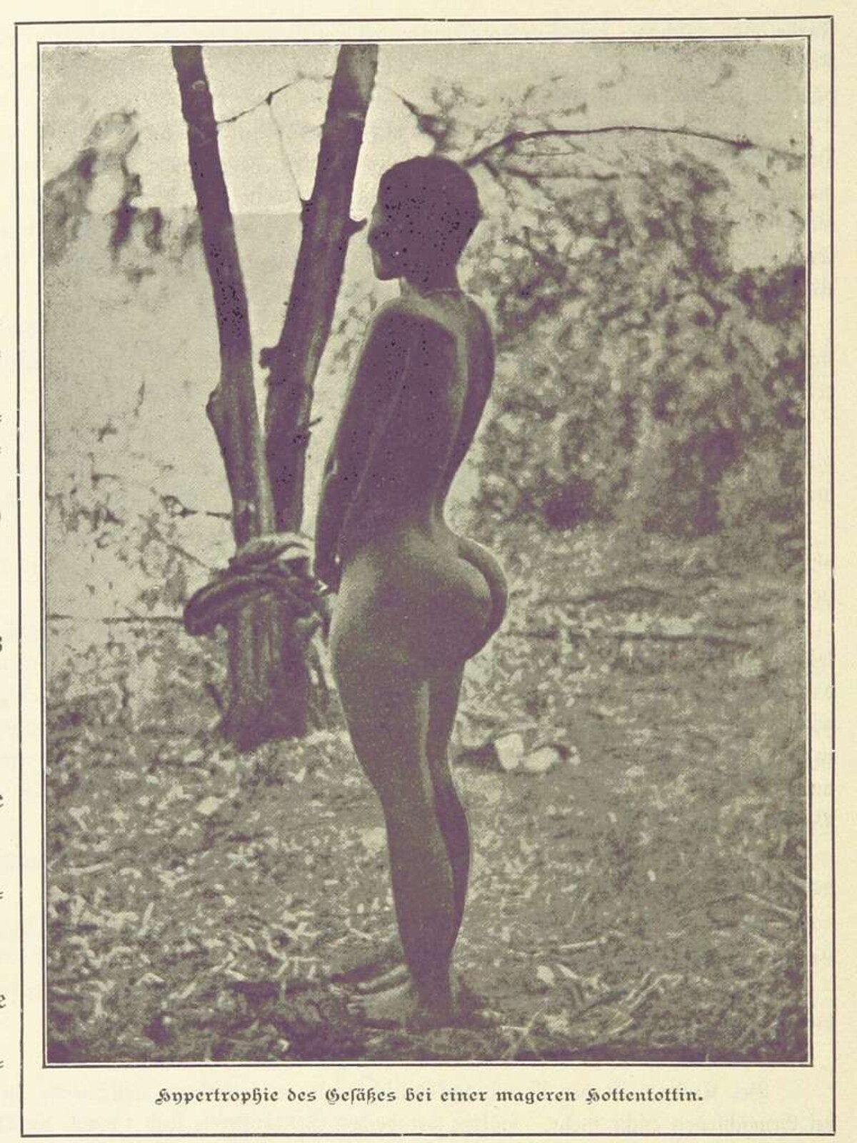 Ilustračná fotografia steatopýgie z roku 1869.