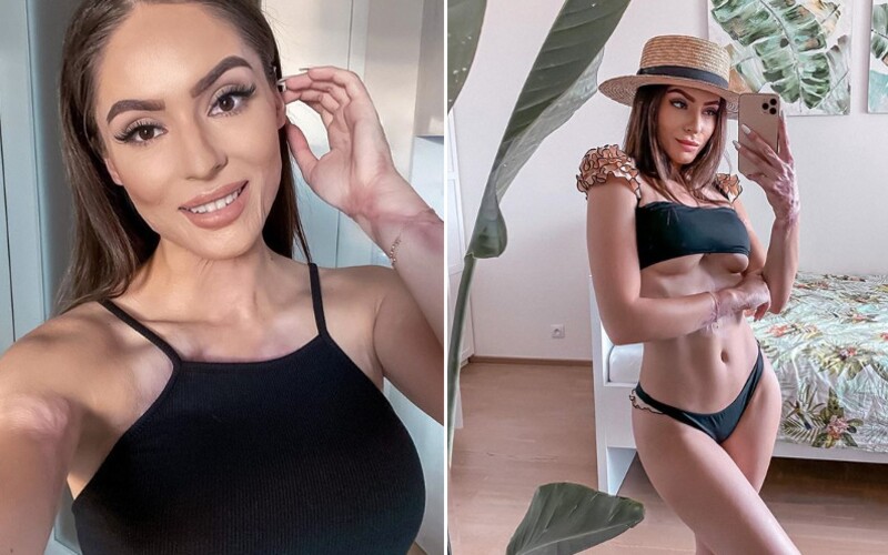 Týnuš Třešničková své jizvy po popáleninách miluje. Influencerka je dnes velkou inspirací pro skoro 500 000 followerů.