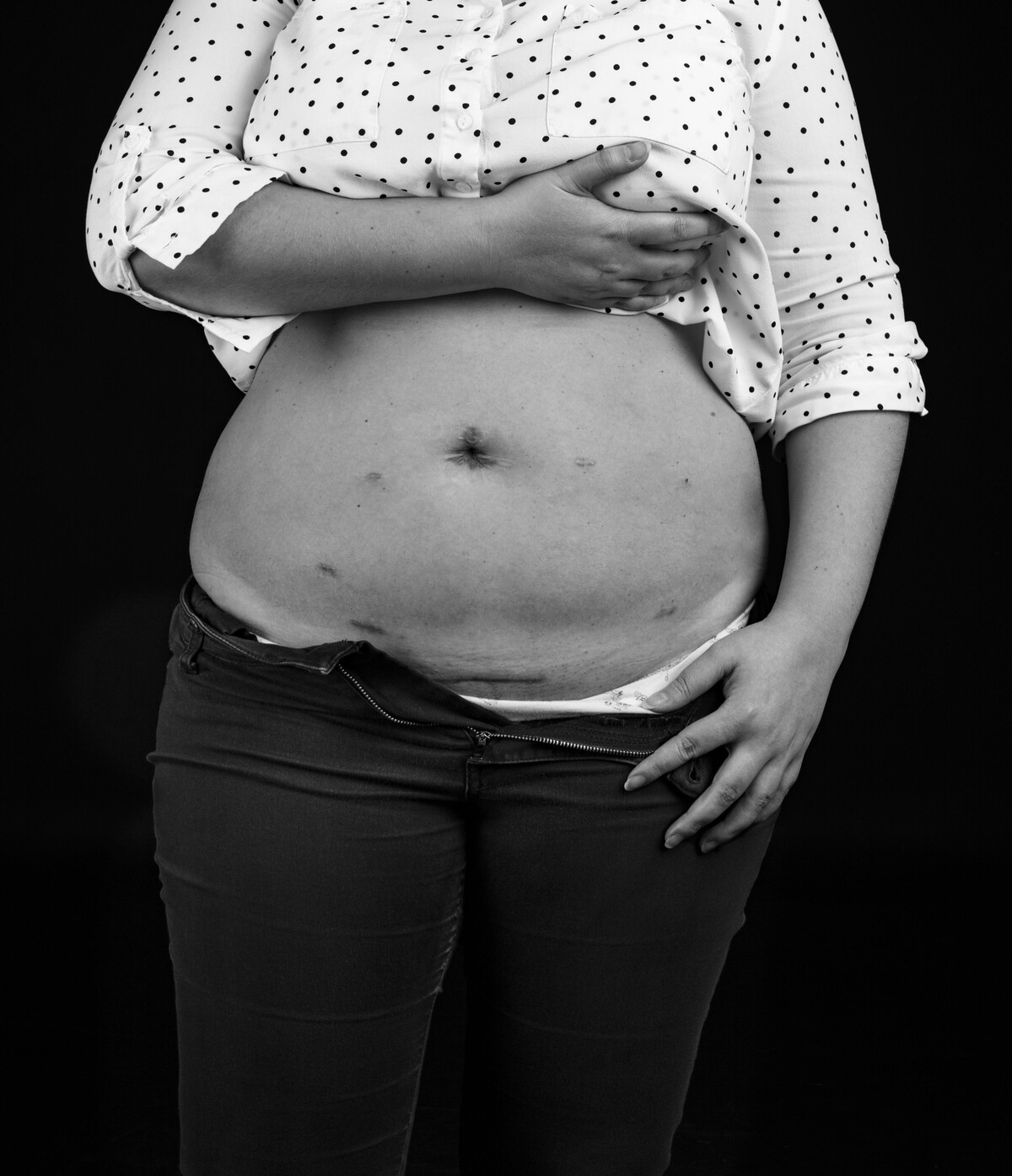 endometrioza