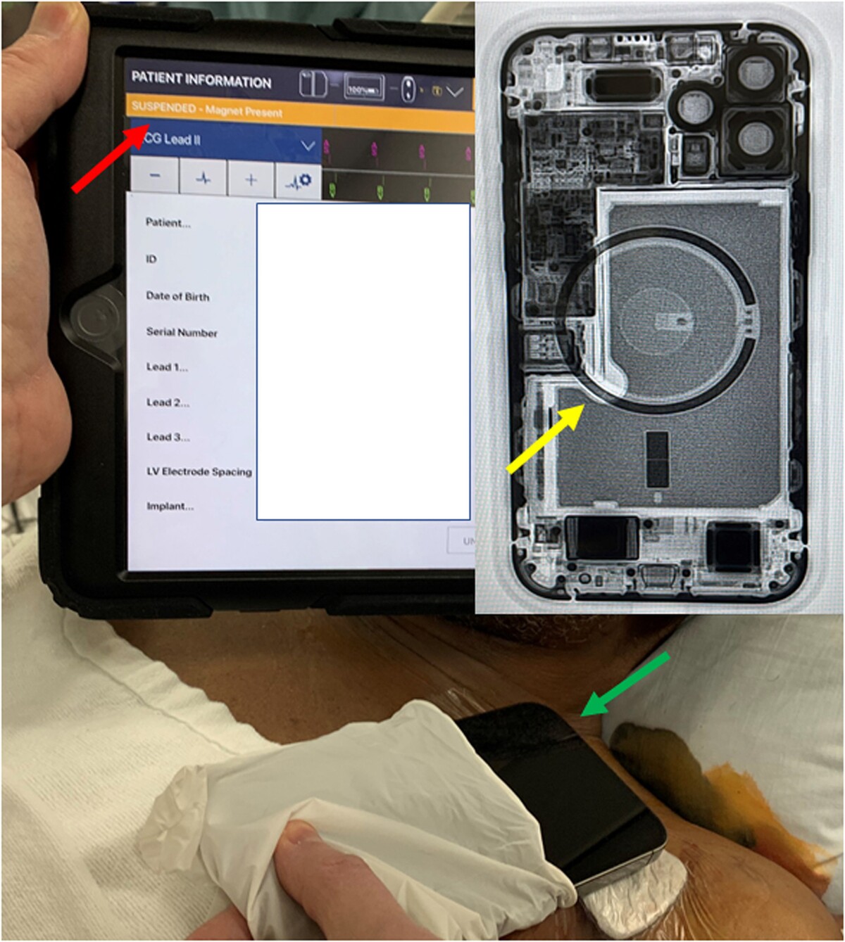 Štúdia ukazuje ako kardiostimulátor pozastavil činnosť pre prítomnosť magnetu. Pritom mal pacient iba iPhone 12 na hrudníku.