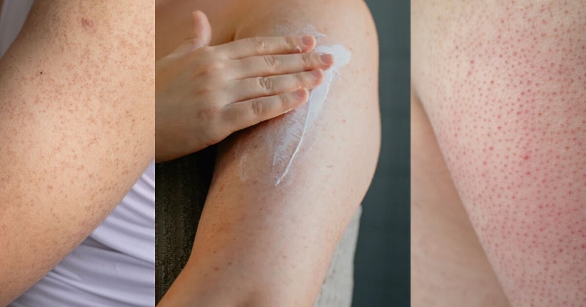 Malé hrbolky, které vypadají jako husí kůže? Možná se jedná o keratosis pilaris a s tím se dá něco dělat