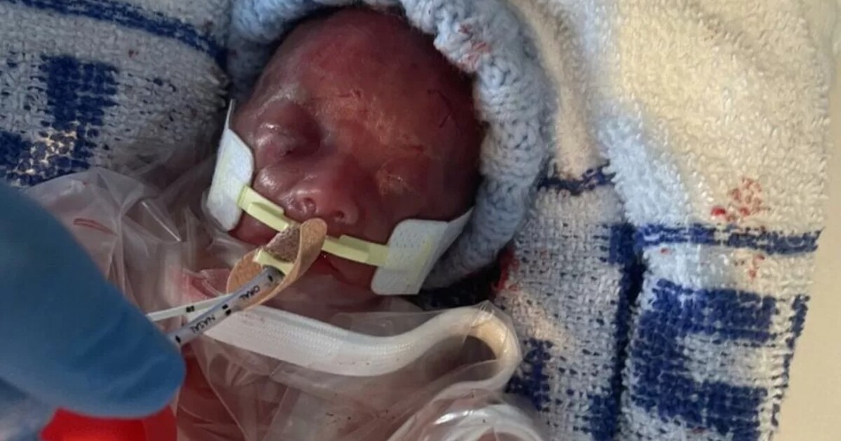 Lékaři jí dali šanci 10 procent na přežití. Holčička narozená ve 22. týdnu už je doma s rodiči