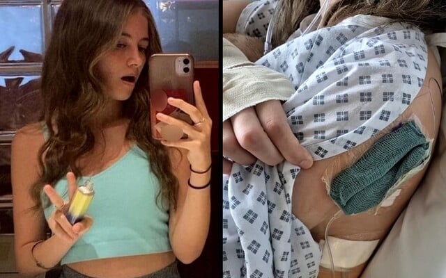 Mladá dívka po nadměrném vapování zmodrala. Lékaři jí museli odstranit část plic