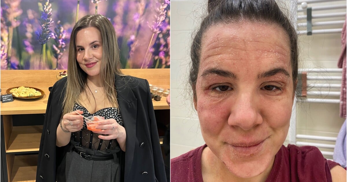 Dlouhodobá léčba ekzému změnila Terezu k nepoznání: „Kvůli bolesti jsem nemohla ani obejmout vlastní děti. Kůže mi hořela“