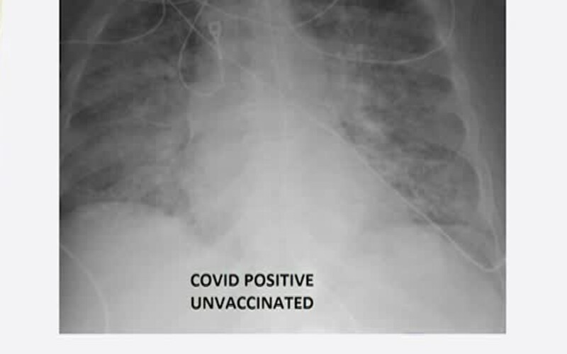 Obrovský rozdiel medzi pľúcami očkovaného a neočkovaného pacienta s koronavírusom. Touto snímkou lekár otvára ľuďom oči.