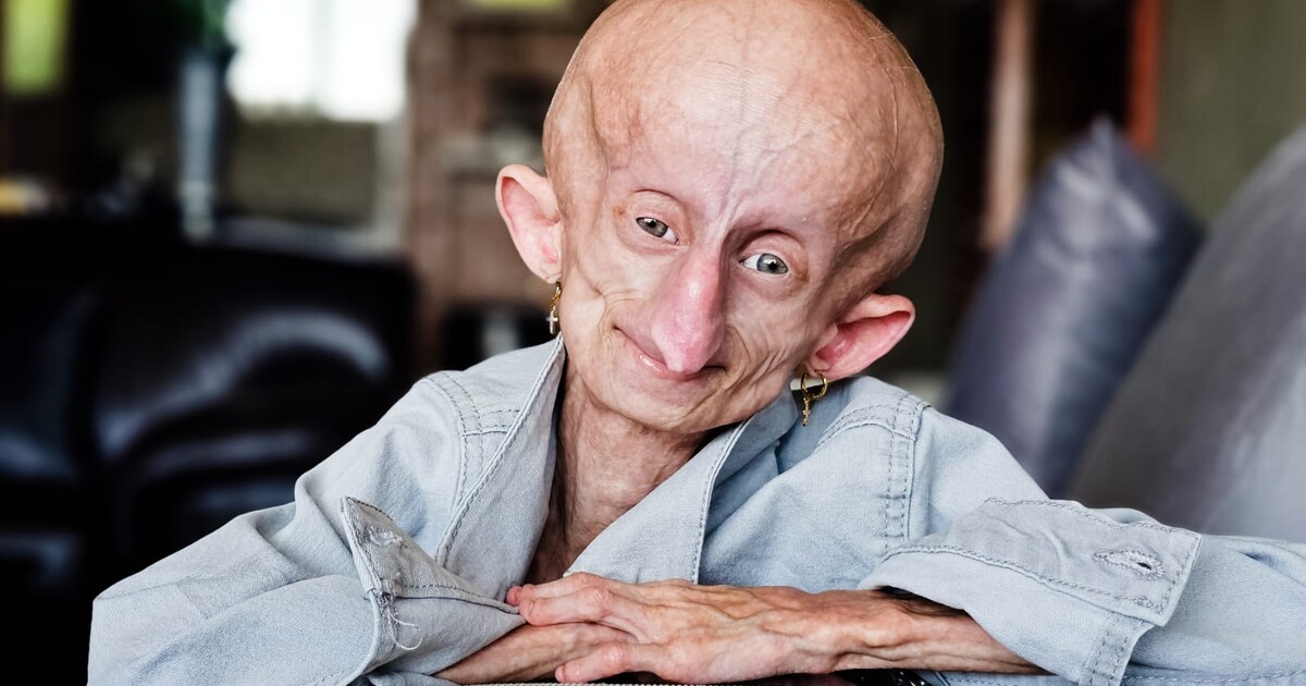 Zemřela influencerka, která trpěla nemocí předčasného stárnutí. Bylo jí 19 let