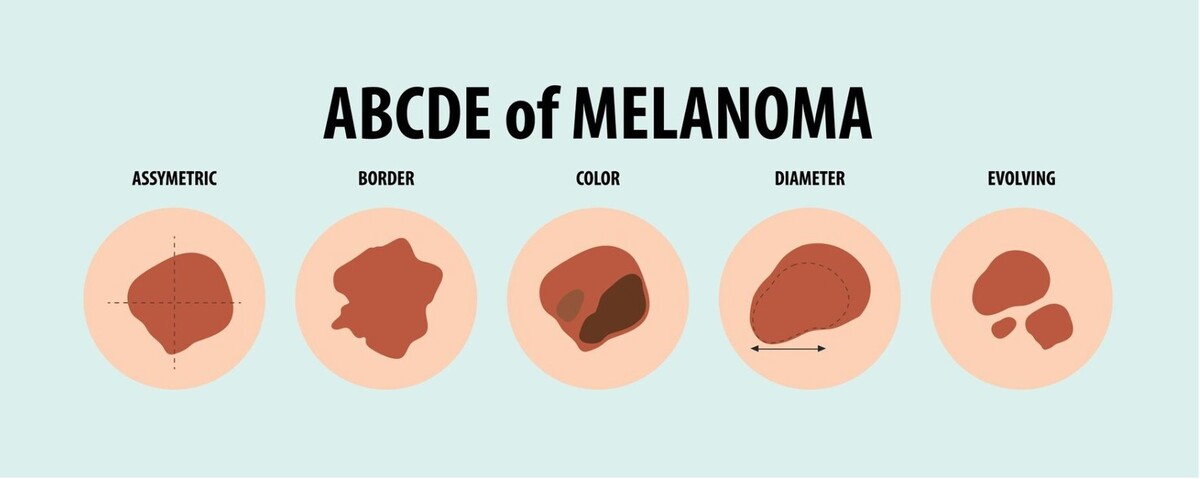 melanom, rakovina kůže