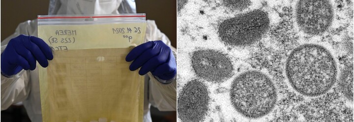 WHO přejmenuje virus opičích neštovic. Chce zabránit diskriminaci