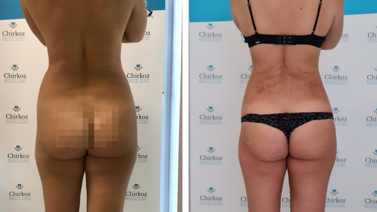 liposukcia