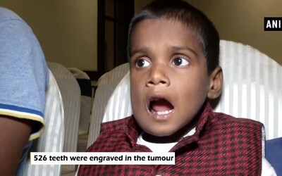 Sedmiletému chlapci vytrhli 526 zubů, ukrývaly se v dolní čelisti