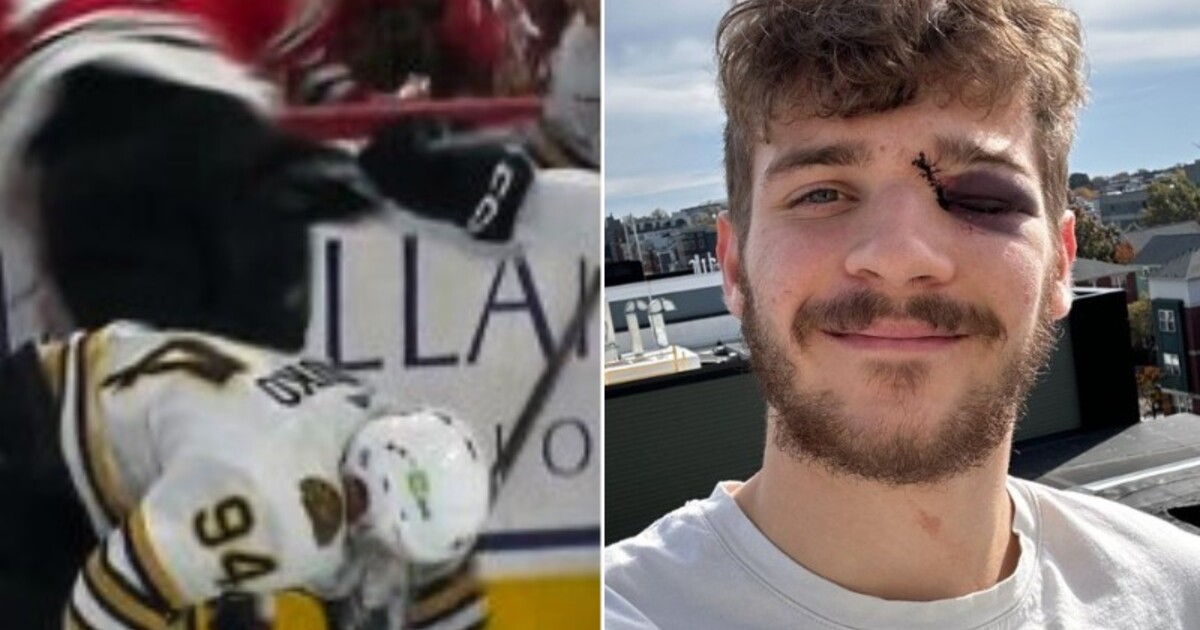 VIDEO: Český hokejista po děsivém zásahu bruslí téměř přišel o oko. „Modelingová kariéra je ohrožena,“ žertuje.