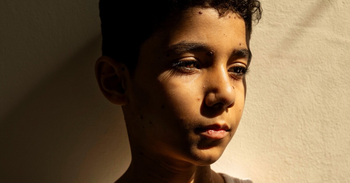 World Press Photo zná svého vítěze. Stala se jím fotka malého Palestince, který během války přišel o ruce