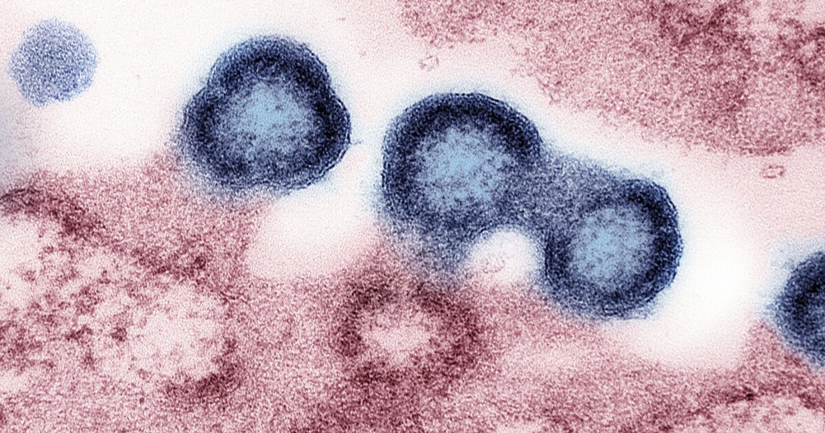 Úmrtnost na AIDS se může zvýšit o 400 %, upozorňuje OSN. Obává se kroků Donalda Trumpa