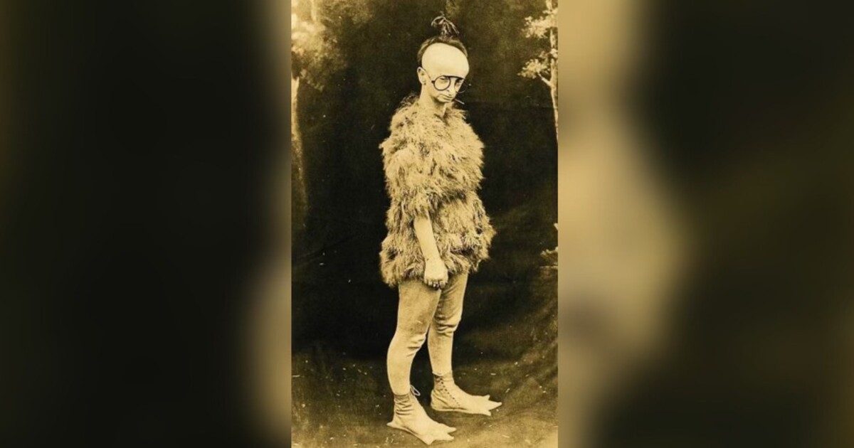 Minnie Woolsey se narodila se vzácnou nemocí, připomínala ptáka, byla téměř slepá a neměla zuby. Přesto se stala celebritou filmu