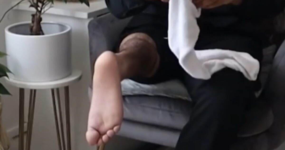 Muži přišli amputovanou nohu špičkou dozadu. Zachránilo mu to život