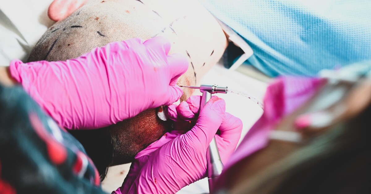 V Turecku zemřel muž při levné transplantaci vlasů. Klinika tvrdí, že neudělala chybu