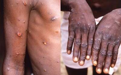 Opičí neštovice: Potvrzeno je již 80 případů ve 12 zemích světa včetně Evropy.