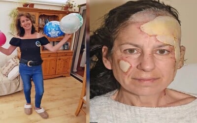 Chtěla si jen zapálit cigaretu, místo toho jí shořela část obličeje. Nešťastná nehoda jí způsobila popáleniny třetího stupně.
