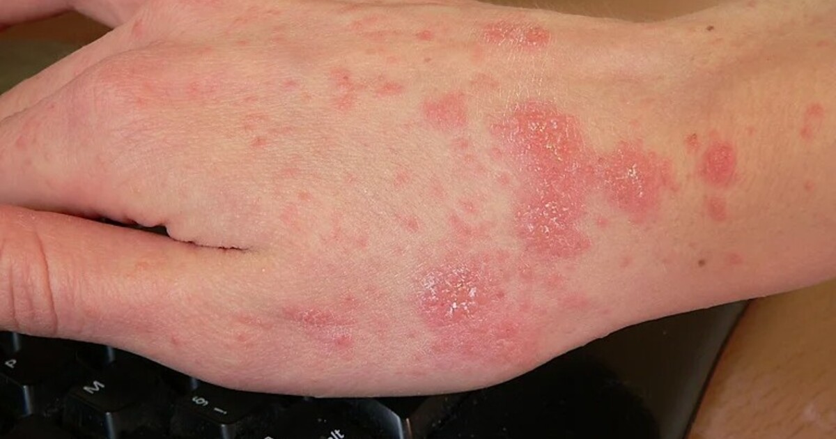 Svrab v Česku rekordně roste. Nejhůře je na tom Moravskoslezský kraj