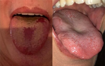 Co je covidový jazyk? Epidemilog popsal další příznak nákazy koronavirem.