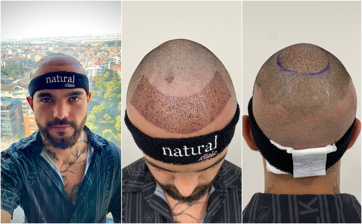 Český youtuber Freescoot po transplantácii vlasov v Istanbule.