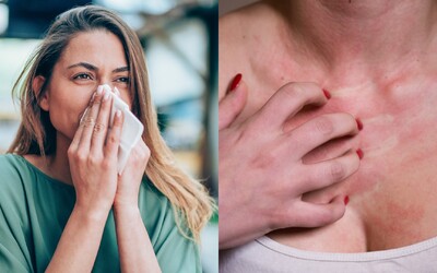 Alergia na ejakulát, šport či peniaze. Aké sú príznaky netradičných alergií? Odpovedá odborník