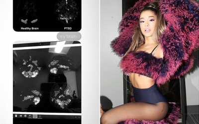 Ariana Grande odhaľuje škvrny na mozgu. Spôsobila ich trauma z teroristického útoku počas jej koncertu, kde zahynulo 23 ľudí