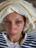 Bella Hadid zdieľala fotku z nemocničného lôžka. Trpí zákernou chorobou