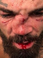 Bojovník UFC utrpěl děsivou zlomeninu nosu. Dostal do něj tvrdou ránu kolenem
