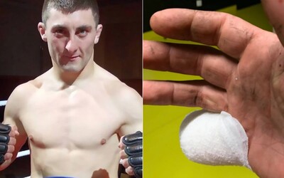Bojovníkovi MMA odsekl kombajn kus malíčku. K lékaři šel až poté, co dokončil sklizeň