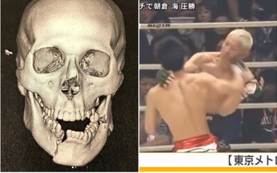 Bývalý UFC bojovník utrpěl děsivou zlomeninu čelisti. Na Instagramu ukázal snímky z rentgenu