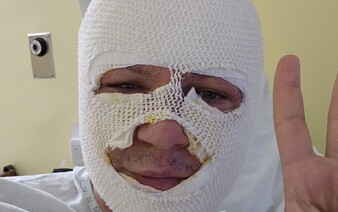 Bývalý poslanec Miroslav Žiak zverejnil fotku tváre po vážnych popáleninách. Svojim sledovateľom poslal odkaz